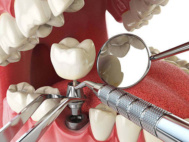 Best Emergency Tooth Extraction in Hardin, MT